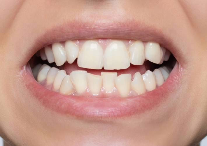Scheve tanden voor het plaatsen van WellaSmile