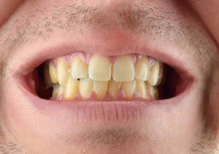 Vergeelde tanden bedekt door het egale wit van WellaSmile