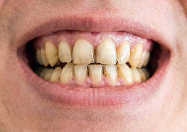 Tandvlekken bedekt door WellaSmile